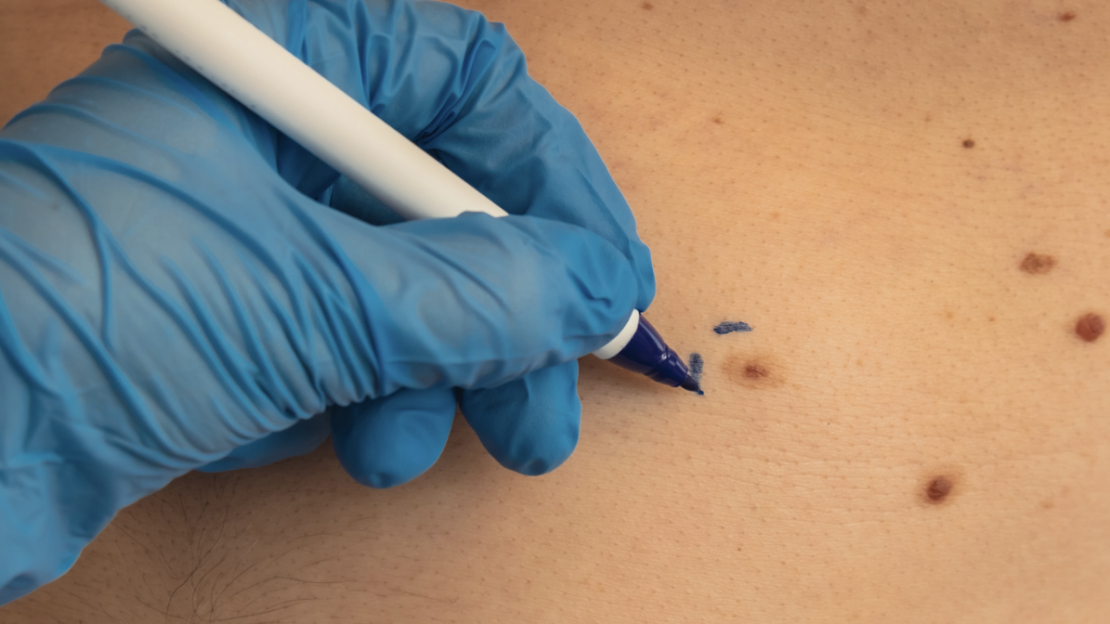 Skin Tag Checked in Calvert County MD